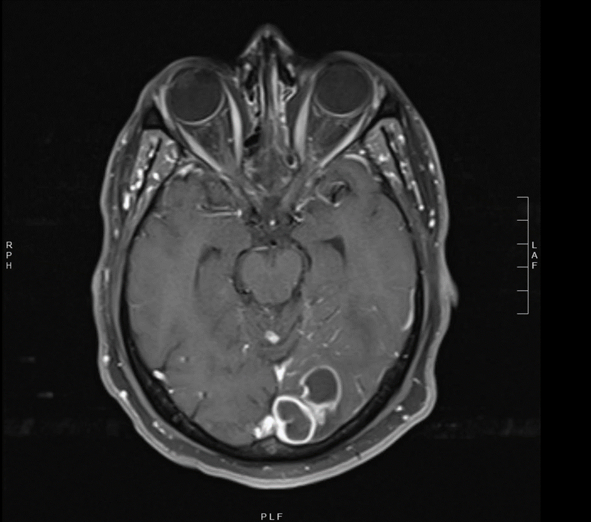 Case Of Mistaken Identity Cerebral Cryptococcoma In An Immunocompetent