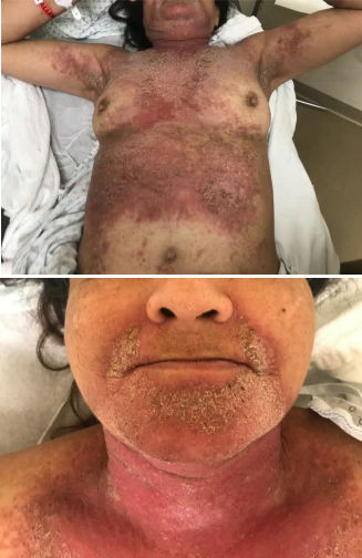 Global Dermatology » Darier's Disease (Keratosis Follicularis)