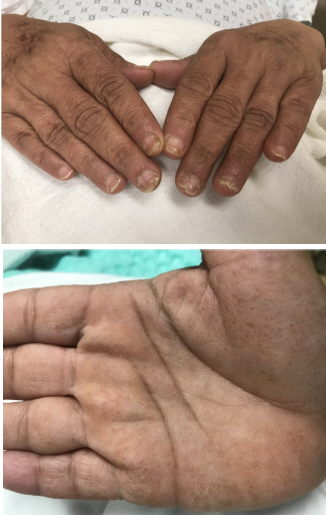 Unilateral monomorphic hypopigmented macules: A variant of Darier disease -  Indian Journal of Dermatology, Venereology and Leprology