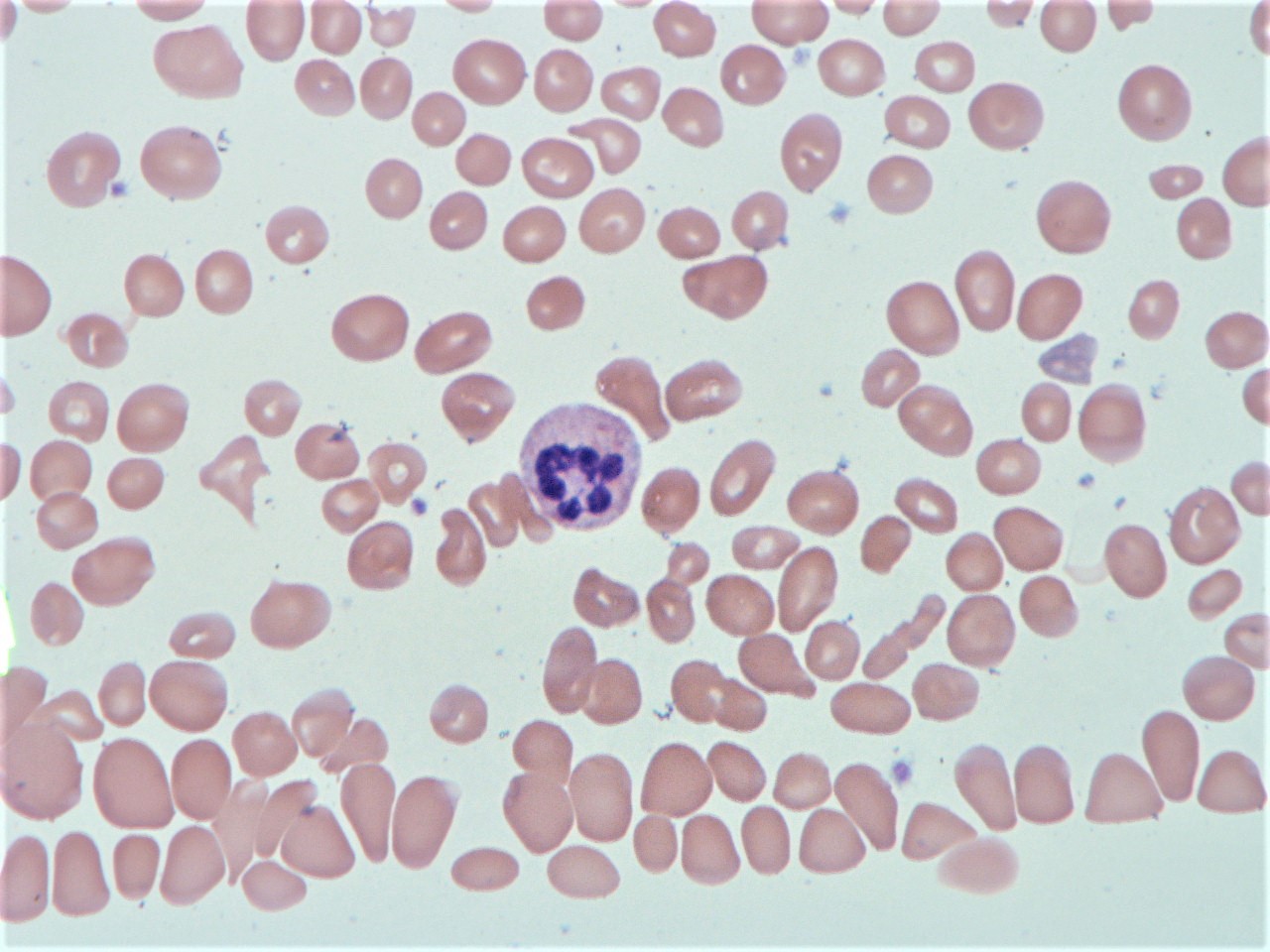 megaloblastic anemia peripheral smear