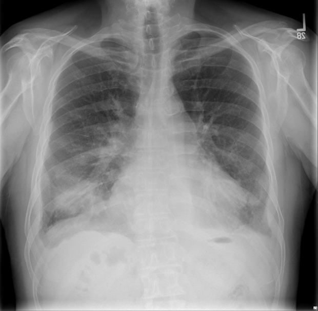 A LUNG MASS THAT VANISHES - SHM Abstracts | Society of Hospital Medicine