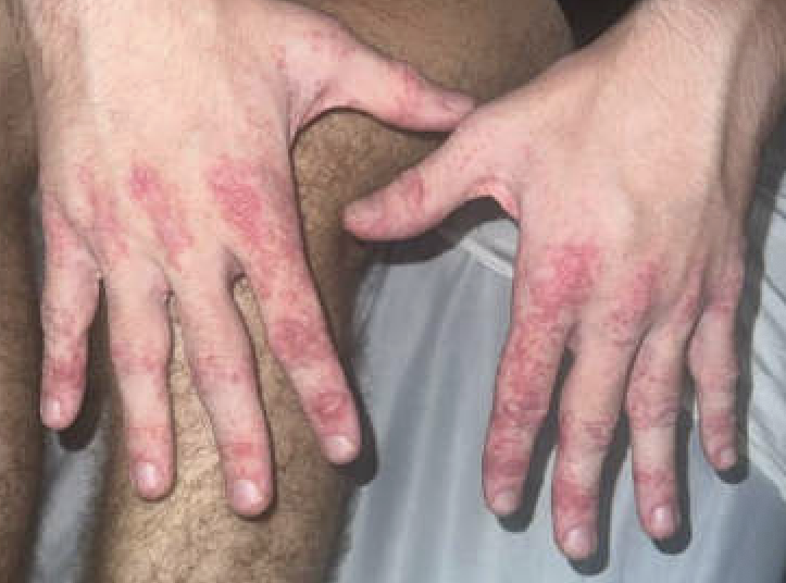 A CASE OF DERMATOMYOSITIS ASSOCIATED WITH EPSTEIN-BARR VIRUS INFECTION - Dermatomyositis | Causes | Best treatment Option | Homeopathic | Best Homeopathic Doctor in Pakistan | Dr Qaisar Ahmed MD, DHMS